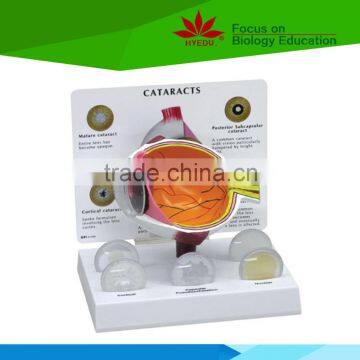 High quality big size human Cataract eye model