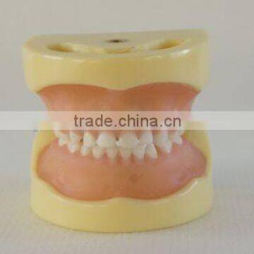 Pediatrics typodont teeth model (20 teeth) with removable screw teeth