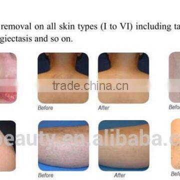 2016 High Technology 808 Laser Hair Removal Machine Portable