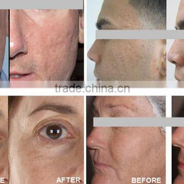 2015 HOT Selling Apolomed 2940nm HS-820 Acne Scar Removal Laser Scar Removal