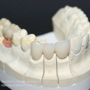 Dental Crown Zirconia Cercon,dental Teeth,dental Prosthesis Laboratoire Dentaire, Dentallabor, Laboratorio Dental, Dental Laboratory, Shenzhen LJ Dental Lab photo-5