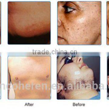 HOT Sell NYC-3 FDA CE Approved Hair Removal Machine,OPT FP Technology photo-6