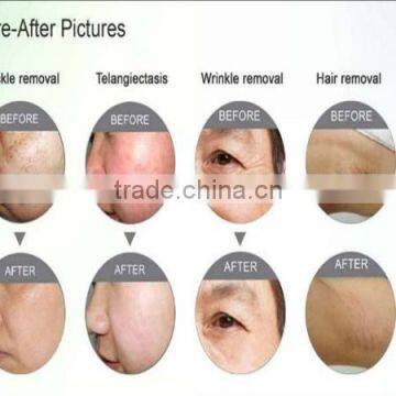 Protable Professional Micro Needle Wrinkle Removal Machine Fractional rf photo-6