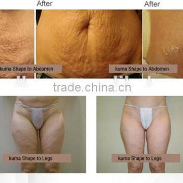 Face Lifting Body Shaping Machine Cavitation+IPL+RF+Vacuum No Pain Reduce Belly Fat Naturally Device Shrink Trichopore photo-6