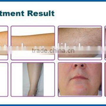3000W 2016 Professional 808 Diode Laser Machine/diode Laser Hair Removal Equipment/808nm Laser Back / Whisker