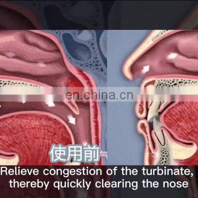 Medical Device for Allergic Rhinitis Acute Rhinitis Rhinitis