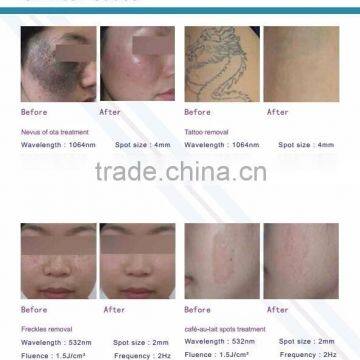 Q-switch 1000W Big Spot Nd Yag Laser for Tattoo Pigment Remaoval FDA Approved photo-4