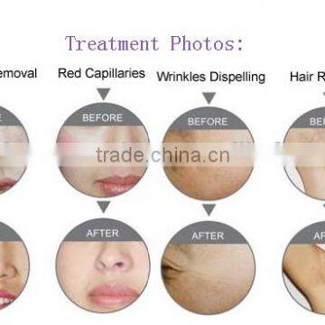 Portable Mini Home Laser Elight IPL Permanent Arms / Legs Hair Removal Hair Removal/IPL RF Facial Skin Rejuvenation Machine Skin Tightening photo-2