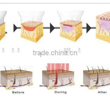 Hot Sale Portable Home-use RF 9D Thermacool Skin Resurfacing and RF Thermacool Effectively Machine photo-3