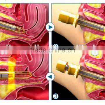 15W(20W) Stationary Vaginal Tighten Beauty Machine/scar Removal Fractional Co2 Laser Wart Removal