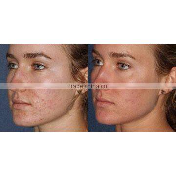 High Quality and Best Price Fractional C02 Laser Beauty Equipment Acne Treatment photo-5