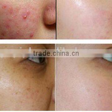 Acne Scar Removal Laser Laser CO2 Resurfacing Machine Treat Telangiectasis From With CE RF Portable Design Fractional Producers Face Whitening