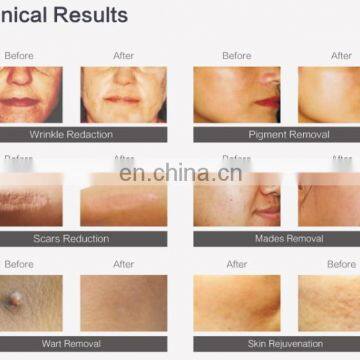 Buy Co2 Laser Choose High Quality GSD Refine Machine for Scar Repair,pigment Removal photo-2