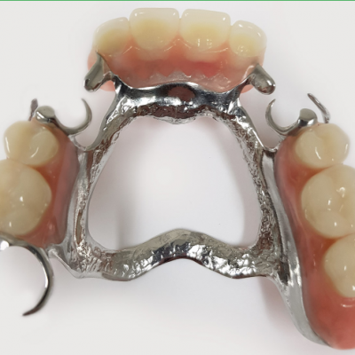 Zirconia All-Ceramic Crowns And Bridges Have No Irritation Or Allergic Reaction To The Gums