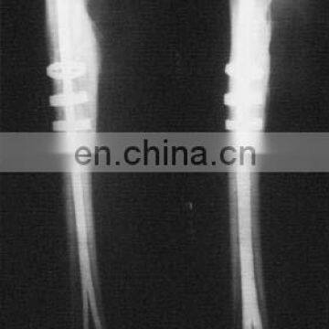 Bone Clasp With Rivet Teeth Ring Shaped TiNi SMA Fixater photo-3