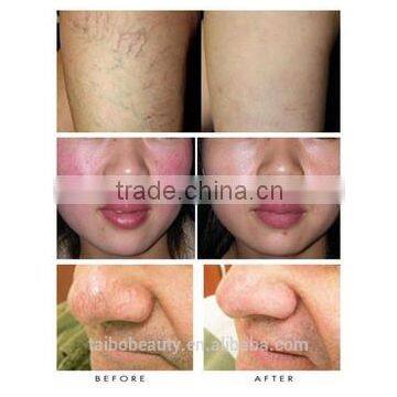 Best Treatment Result Spider Veins Laser Removal Machine EVLT Laser Red Blood Removal photo-6