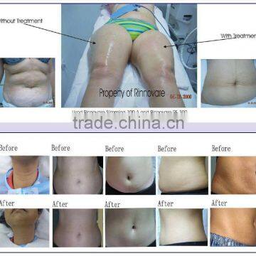 Newest Liposuction RF Vacuum Suction Auto-roller Body Fat Contour Machine photo-6