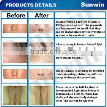 Medical CE Approval Pain Free Fast Hair Removal Elight With Factory Price photo-2