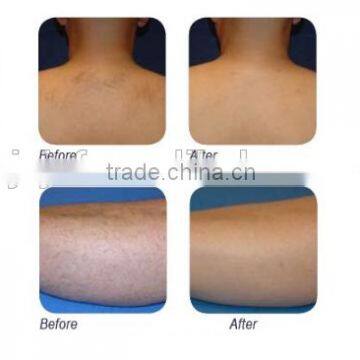 Anybeauty Laser 808T-3 808nm Diode Laser Equipment for Epilation