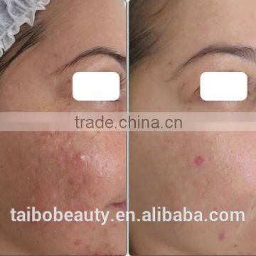 590-1200nm Home Use Mini Hair Removal Machine/laser 560-1200nm Ipl Hair Removal Machines Acne Removal