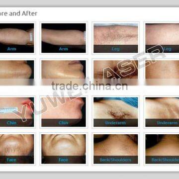 High Effective Painfree 808nm Diode Laser Hair Removal Machine