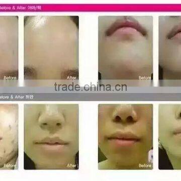 Omega Light Color Therapy Equipment PDT Machine photo-2