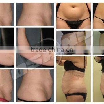 220 / 110V Freezing Pads Cryolipolysis Crypolysis Fat Freezing Machine Vertical photo-4