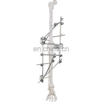 Guaranteed Quality Semi-circular External Fixator Orthopedic Surgical Implant