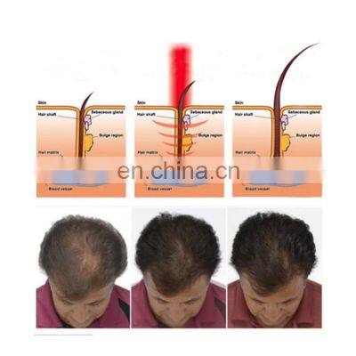 Korean Alopecia Rogaine Hair Regrowth Horse Hair Growth Tonic Laser System Machine Instrements Therapy Equipment in Pakistan photo-3
