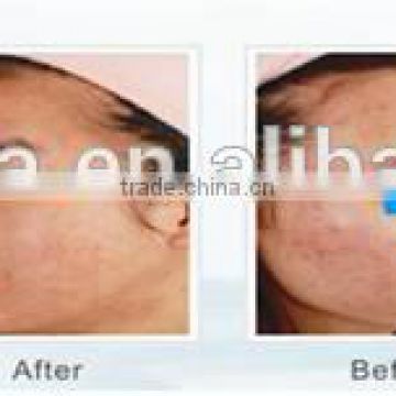 acne vulgaris Treatment/improvement/reduction and skin rejuvenation