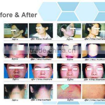 1ms-5000ms Metal RF Co2 Fractional Laser Skin Care And Vaginal Tightening/ Skin Regeneration Laser Machine Coherent Laser Tube/ Fractional Co2 Laser High Ene RF RF