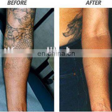 Switch ND YAG Laser Price/tatto Removal Machine/ q Swithed Laser