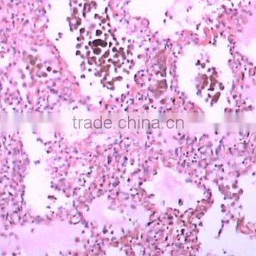 Individual slides you can choose from Educational human tissue pathology of Cancer lymph node metastasis prepared slides