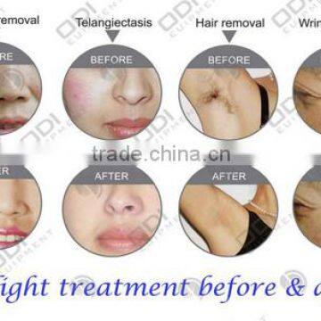 Beauty Machine Beauty Salon/spa OD-IRL10 nd Yag Tattoo Removal Hair Removal RF E Light Laser Ipl photo-6