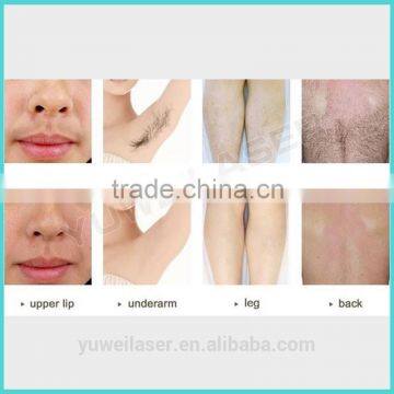 New Innovative Technology New Diode Laser 808nm Hair Removal Machine