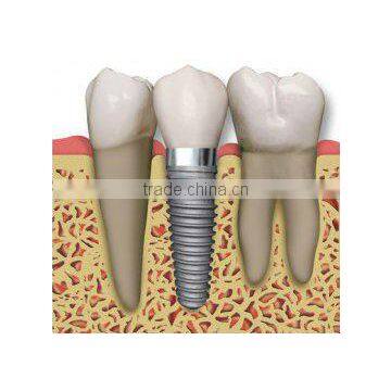 dental implants