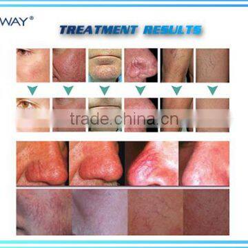 Removing Spider Veins Nose / Treatment Spider Veins Nose / Vascular Machines Spider Vein photo-4