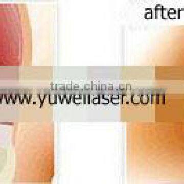 Big Discount ! Co2 Fractional Laser for Scars Removal Device photo-6