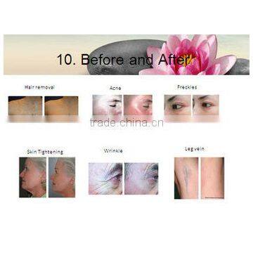 FDA Elight Ipl Hair Removal Machine Med-230 photo-4