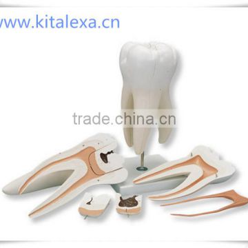 KA-TP00013 Maxillary three dental caries model (Part 2)