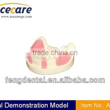 Hot sale and high quality Implant practice model AC-P8