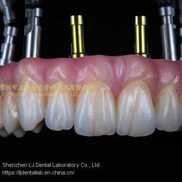 Dental implant prosthesis, implant denture, dental prosthesis, laboratoire dentaire, Dentallabor, laboratorio dental, dental laboratory, Shenzhen LJ dental lab China