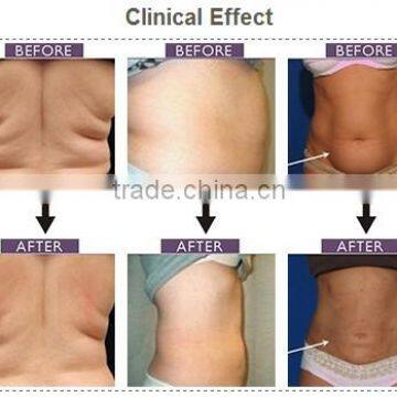 Oem Odm Safe and Effective Radio Frequency Ultrasonic Cavitation Freeze Fat Reducing Fat Apparatus For Sale photo-6