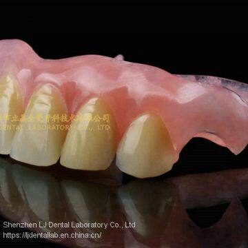Dental valplast denture, acrylic denture, dental prosthesis, laboratoire dentaire, Dentallabor, laboratorio dental, dental laboratory, Shenzhen LJ dental lab China
