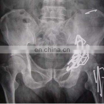 Acetabulum Anterior Column Dissection TiNi SMA Fixater Type II