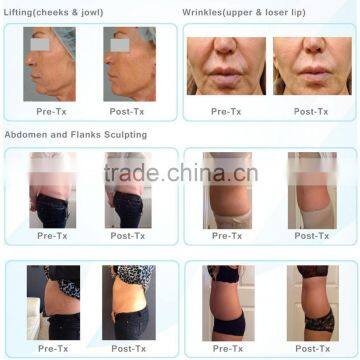 Latest Technology Hifu Ultrasonic Lposuction Equipment Skin Lifting V8 Body Shaping Machine Skin Rejuvenation photo-3