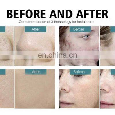 Portable Beauty Equipment Home Diamond Dermabrasion Tips Microdermabrasion Machine for Sale photo-3