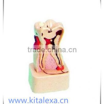 KA-TP00015 Dental pathological model