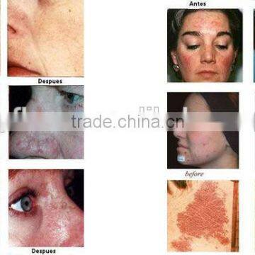 630nm Blue 2016 Most Popular !! Pdt Led Bio-light Therapy Beauty Machine With CE Spot Removal photo-6