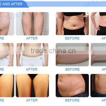 Body Contouring Cryolipolysis Fat Freezing Slimming / Cryolipolysis Cavitation Double Chin Removal Rf Slimming Machine / Vacuum Cryolipolysis Machine Weight Loss photo-5